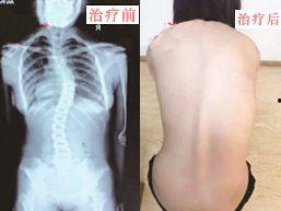 脊椎弯曲矫正视频成人