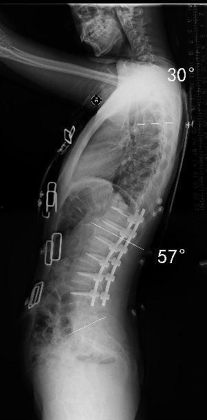 脊椎弯曲矫正视频成人